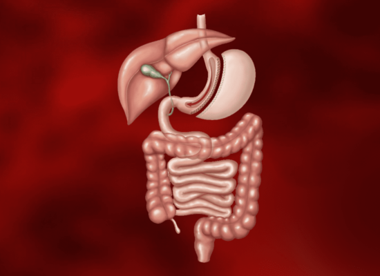 Cirurgia Bariátrica Gastrectomia Vertical – Sleeve