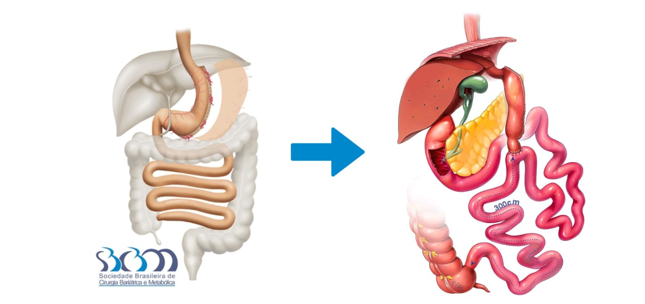 Sleeve Gástrico: O que é e para quem é indicado
